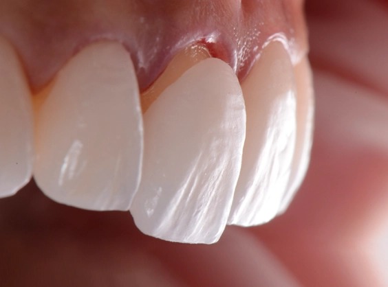 The Hollywood Smile Clinic Portfolio of Life-Changing Smiles